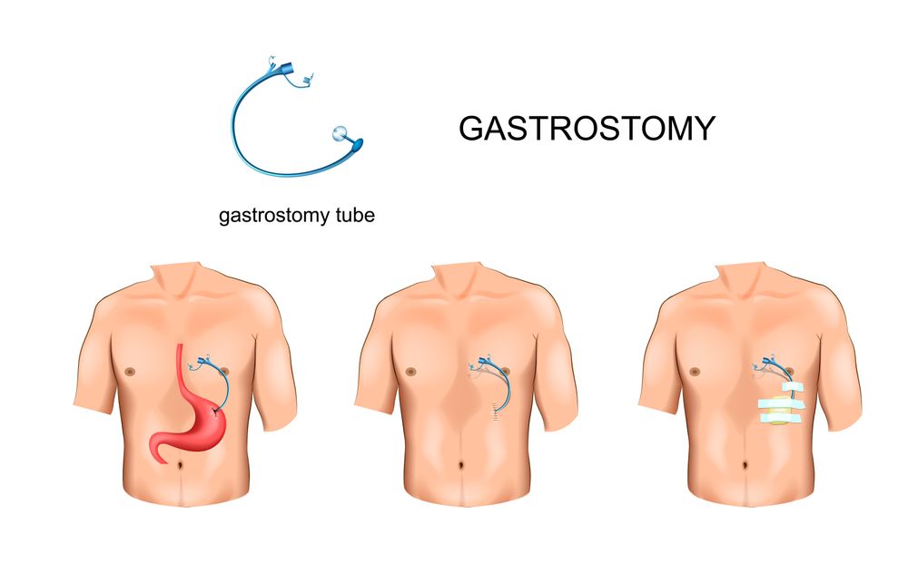Pros and Cons of Feeding Tubes in Elderly Caregiver Relief