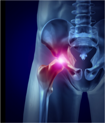 Hip Replacement Recall: Dangerous Side Effects of the DePuy ASR Hip System